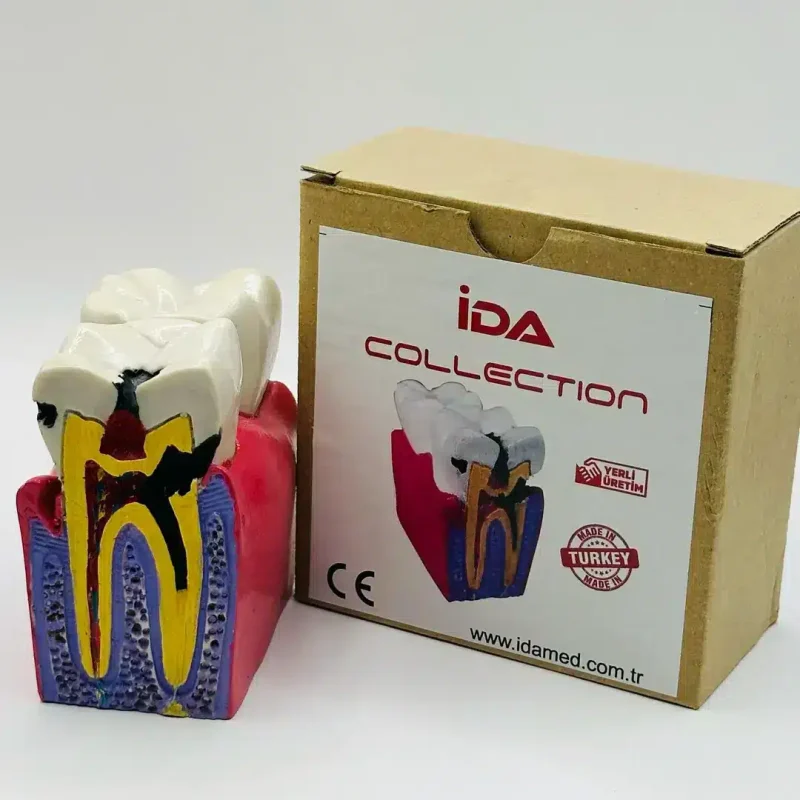 İDA Çürük Diş Modeli 2 diş (Büyük boy)