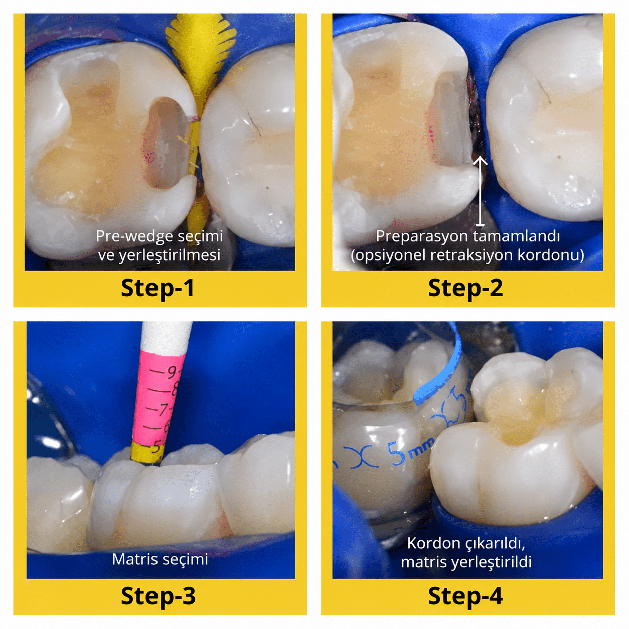 EVOLVE POSTERIOR MATRIX REFILLS uygulama 1