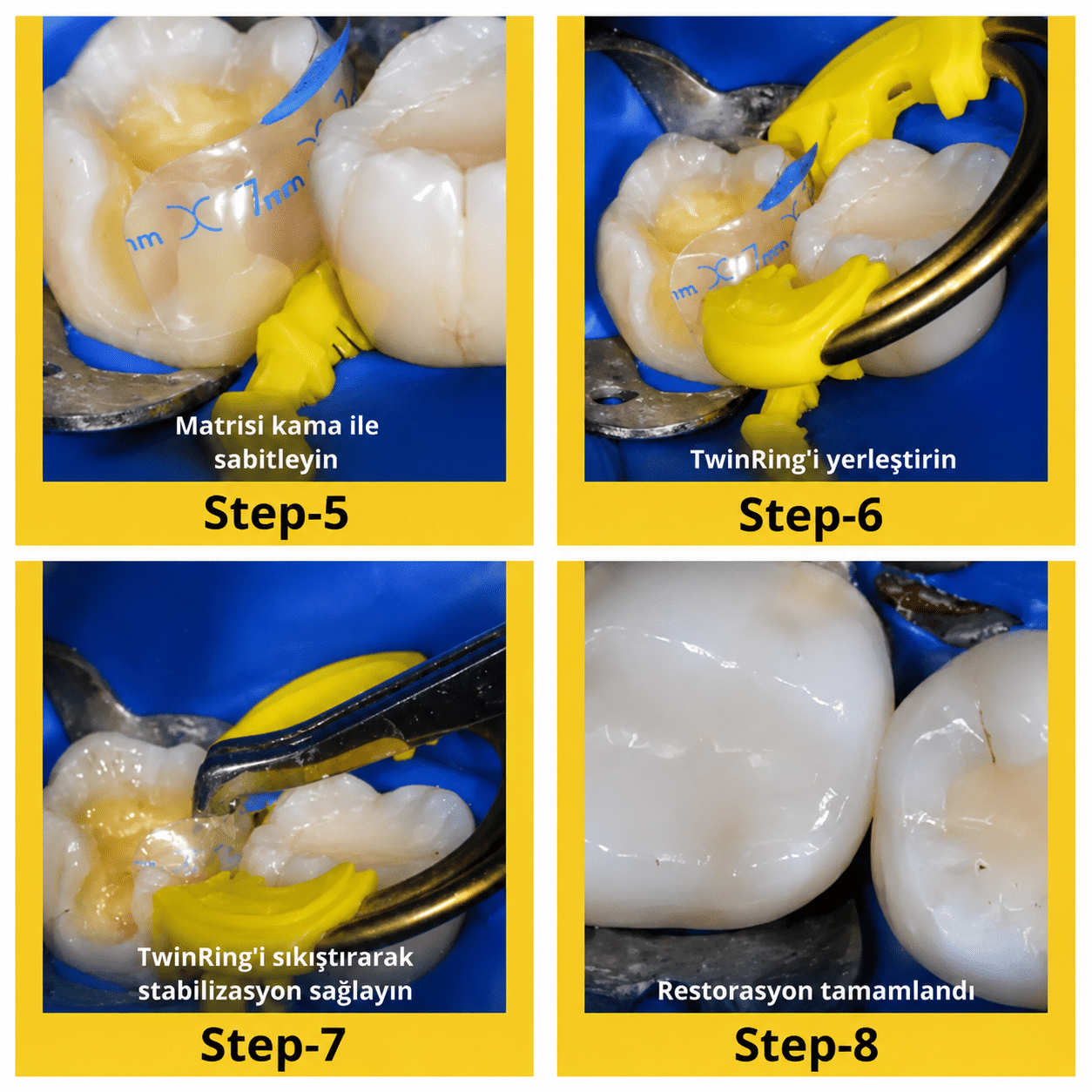 EVOLVE POSTERIOR MATRIX REFILLSuygulama 2